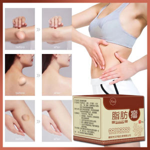 Kem tan u mỡ Tan u cứng U mỡ Kem u tuyến giáp 30g Kem tan mỡ chính hãng