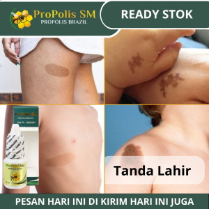 Obat Penghilang Tanda Lahir Herbal Tanda Lahir Merah Menonjol Pada Bayi Obat Oles Gumpalan Darah Pada Bayi Memudarkan Tanda Lahir Hitam Coklat Merah Hemangioma Kotoran Lalat Obat Oles Atasi Tanda Lahir Di Sekujur Tubuh Dengan ProPolis SM