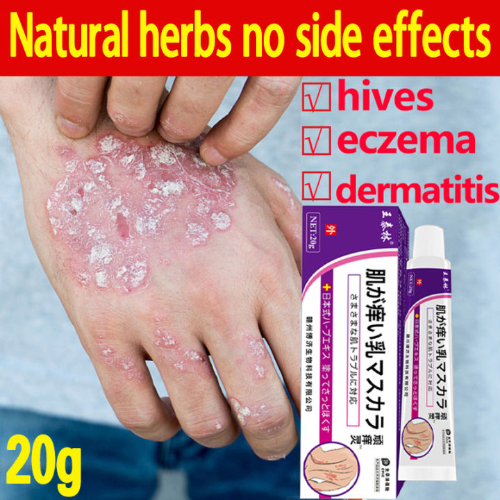 Psoriasis Eczema Treatment Ointment 20g for Itchy Skin Allergy Eczema