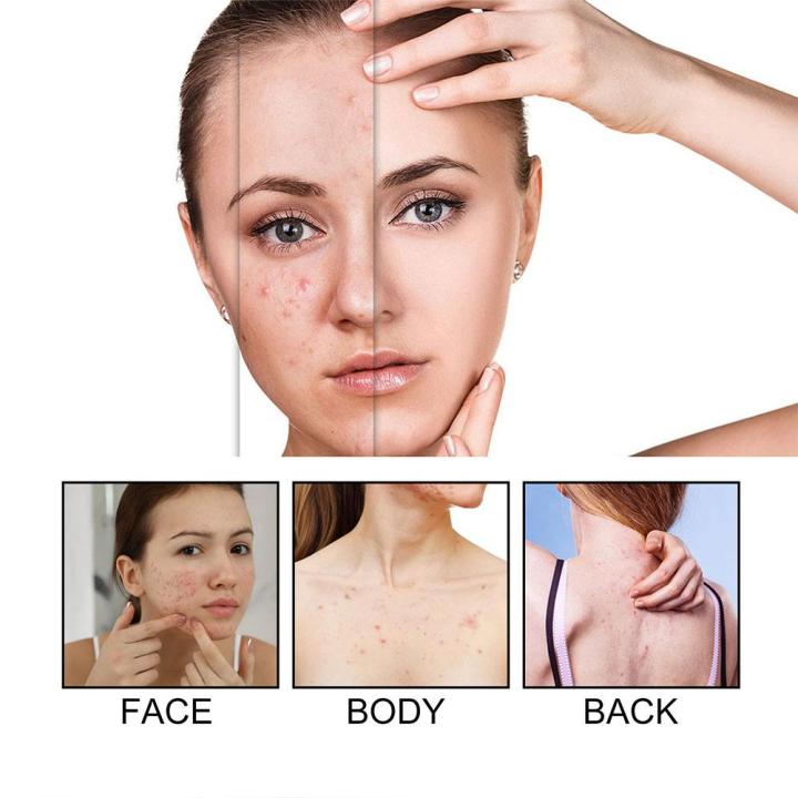 Pimple Protection Colorful Acne Removal Patch Pimple Patch Invisible Spot Cover ...