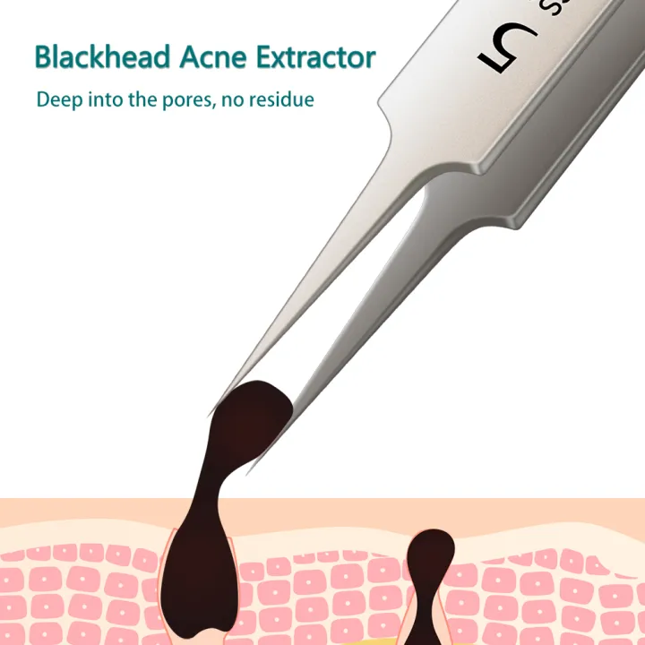Blackhead%20Remover%20Tweezers,%20Blackhead%20Remover%20Comedone%20Extractor%20Stainless%20Steel%20Precision%20Pimple%20Popper%20Tool%20for%20Whitehead%20Acne%20Blemishes%20-%20Image%206