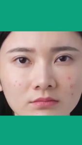 Facial Cream Tea Tree Anti Acne Pimple Removal Spots Oil Control Shrink Pores Moisturizing Cream