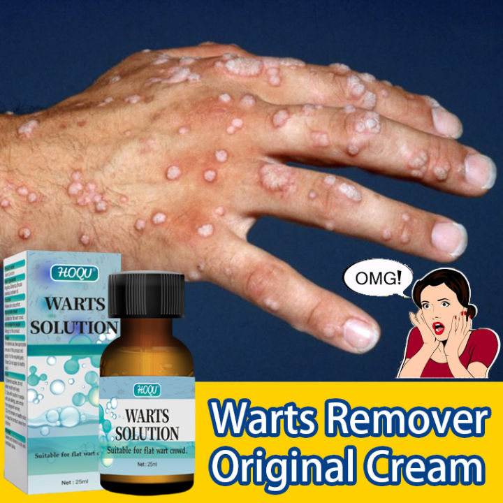 Warts Removal Serum Warts Remover Original Oil 25ml Wart Removing Liquid Genital Warts 8956