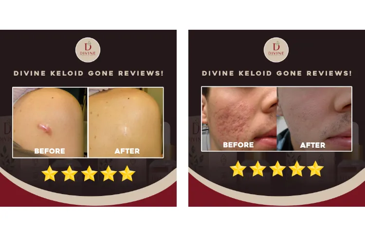 Keloid Gone Scar Remover Original Face Scar Keloid Remover Pimple