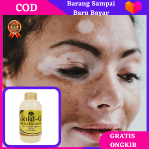 Vitiligo White Spot Repigmentation Kulit/ Ampuh Obat Oles Herbal Penghilang Vitiligo/ Obat Vitiligo Bintik Putih Sembuh Dalam 2 Minggu