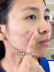 郁美净青少年控油净透面膜Yumeijing Mask Youth Oil Control Purifying Essence Moisturizing 13 to 18 Years Old🍍0907