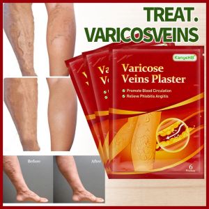 【Fast Delivery】Pain Relief 6pcs/12pcs/24pcs/30pcs Varicose Vein Patch Pain Relief Pain Relief Knee Patch Muscle Health Care Chinese Varicose Veins Plaster Vasculitis Phlebitis Spider Leg Medical Patch Angiitis Removal Patch