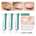 BREYLEE Acne Scar Removal Cream Repair Stretch Marks Pimple Marks Skin Care. 