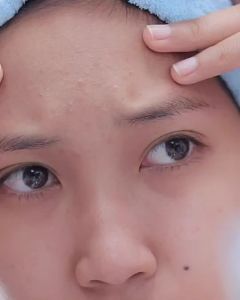 Youvit Niacinamide Gummy 30 Days Anti Acne with Vitamin A Retinol Alternative (30 Pcs)