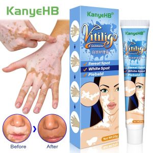 20g Herbal Extract Vitiligo Ointment Remove Ringworm White Spot Removal Skin White Spot Leukoplakia Disease Treatment Cream
