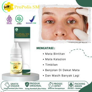 Obat Mata Bengkak Bintitan / Kalazion Timbilan Di Kelopak Mata Hordeolum Pengempis Benjolan Di Dekat Mata Dengan ProPolis SM