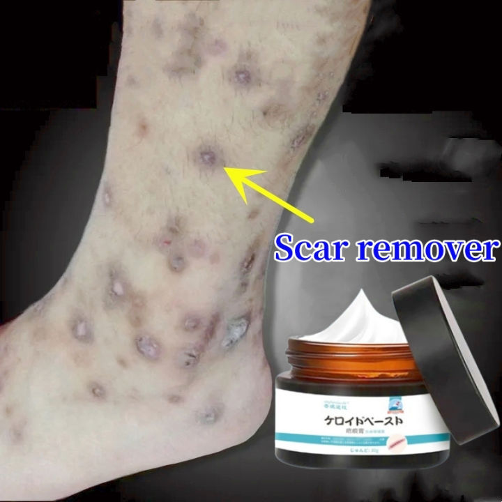 Peklat remover Peklat remover cream for leg Insect bite scar remover