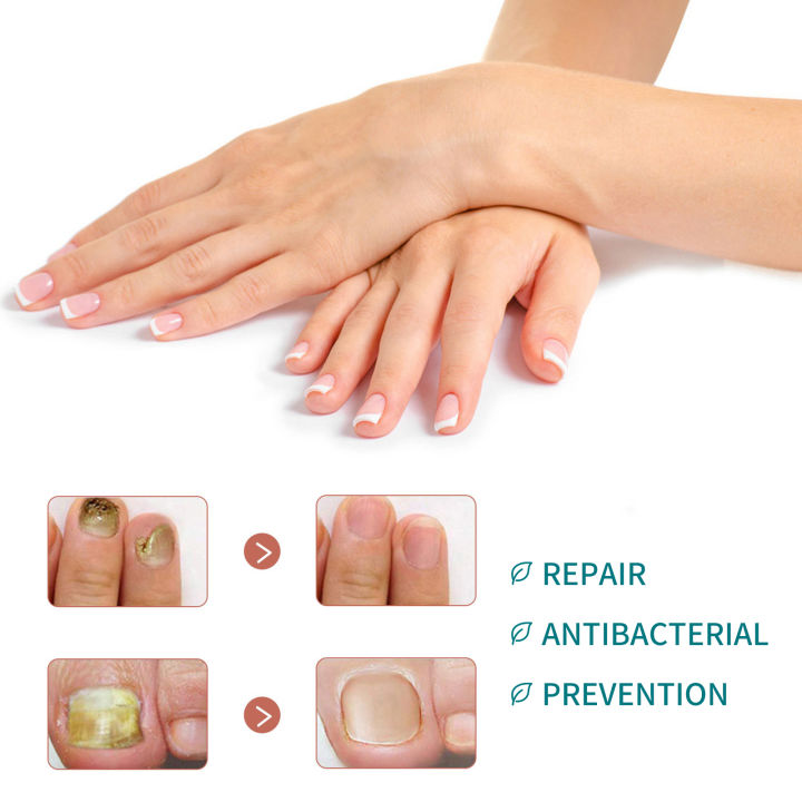 %E3%80%90100%25%20Effective%E3%80%91Jaysuing%20Fungal%20Nail%20Treatment%20Patch%20Anti%20Infection%20Paronychia%20Thickening%20Soft%20Waterproof%2032pcs%20-%20Image%205