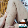 Japan Penghilang Bekas Luka Scar Cream Removal Krim Penghilang scar keloid bopeng bekas luka lama dan baru Old Scar Remover Gel Repairs Whole Body Scars Stretch Marks Pockmarks and Acne Marks 30g. 