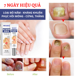 Kem loại bỏ hết sạch nấm móng vàng móng ngứa móng WEST & MONTH Chống Nhiễm Trùng Móng bỏ nấm nhiễm trùng kem dưỡng và kháng khuẩn cho móng chân tay thêm bóng khỏe