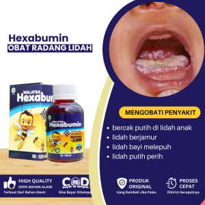 Obat Radang Lidah Bayi Obat Bercak Putih Di Lidah Anak Obat Lidah Berjamur Obat Lidah Berwarna Putih Obat Lidah Bayi Melepuh Radang Lidah Anak Lidah Pecah Pecah Perih Perih Infeksi Lidah Putih - Walatra Hexabumin