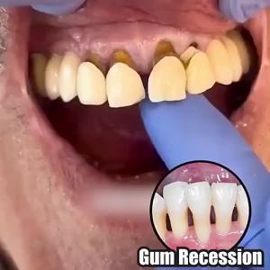 Hot selling products drop directly gum repair gum instant soothing gel gum recession therapy inflammation treatment tooth loosening bleeding gums oral care