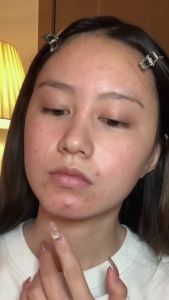 [30g] Acne Gel Pimple & Scar Remover  Fast Acting Anti-Acne Treatment for Face & Pores