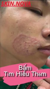 ( COMBO 3 TUÝP TẶNG 2 )Kem Bôi Nấm Ngứa Viêm Da Cơ Địa NHẬT BẢN Hắc Lào Tổ Đỉa Vẩy Nến Á Sừng Lang Ben Hiệu Quả.