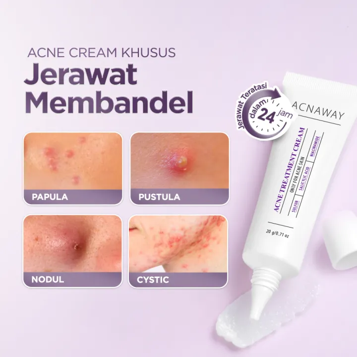 ACNAWAY%20Bundle%202%20in%201%20Acne%20Treatment%20Cream%20+%20Infinity%20Size%20Acne%20Patch%20-%20Image%202