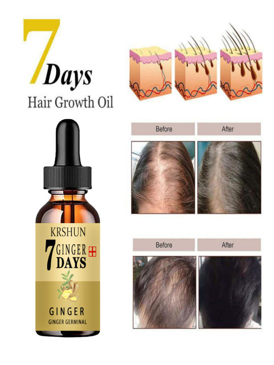 30ML/Hair Growth Serum Anti Preventing Hair Loss Alopecia Liquid ...