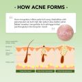 Salep Totol Jerawat Acne Plus BPOM -Spot Care Ekstra Centella Asiatica Anti-Bakteri Penyebab Jerawat. 