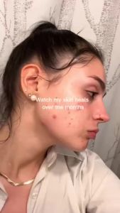 Acne Clear Ampoule with Soothing and Gentle Acne Treatment Serum