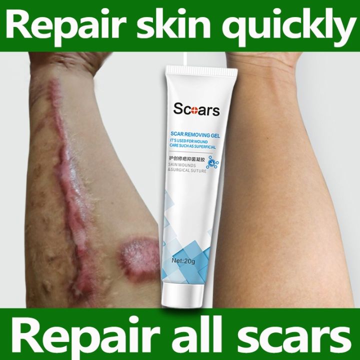 Scar Remover Cream Scar Repair Gel Pregnancy Surgery Burn Scars Stretch