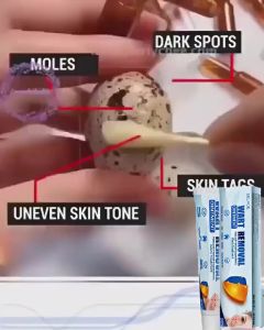 [Effective Care] Warts Removal Cream Warts remover original Mole remover Skin tag remover Painless Warts Treatment COD