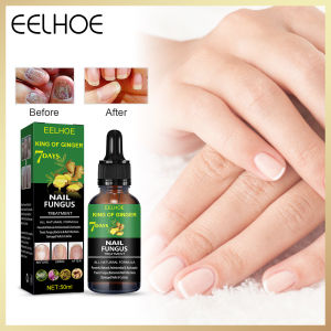 Eelhoe Nail Fungus Treatment Foot Anti-fungal Remove Onychomycosis Care Repair Liquid Healthy Nail Care Repair Toe Nail Fungus Treatment Serum Repair Nail Fungus Anti-bacterial Paronychia Foot Care Nail Fungus Solution Anti-infection Remover Essence 50ml