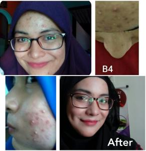 Masker Jerawat Parut Berlubang Magic Tamarind Mask