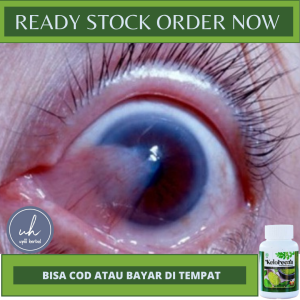 OBAT MATA BERLEMAK OBAT HERBAL MATA BERLEMAK OBAT MATA MINUS OBAT MATA PLUS OBAT UNTUK HILANGKAN SELAPUT PUTIH OBAT MATA KATARAK OBAT PTERIGIUM OBAT HILANGKAN SKINTAG  OBAT MATA KUNING DLL.