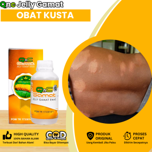Obat Penyakit Kusta Obat Kusta Kering Obat Kusta Kering/ Basah Obat Oles Kulit Kusta Obat Kusta Bunga Obat Menghilangkan Kusta Di Wajah Obat Infeksi Jamur Kulit Kulit Eksim Kudis Dengan Qnc Jelly Gamat
