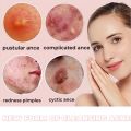 C.three 36Pcs Acne Patch Salicylic Cute Star Invisible Pimple Acne Remover Patch Sticker SkinCare Waterproof TOPITEM👍. 