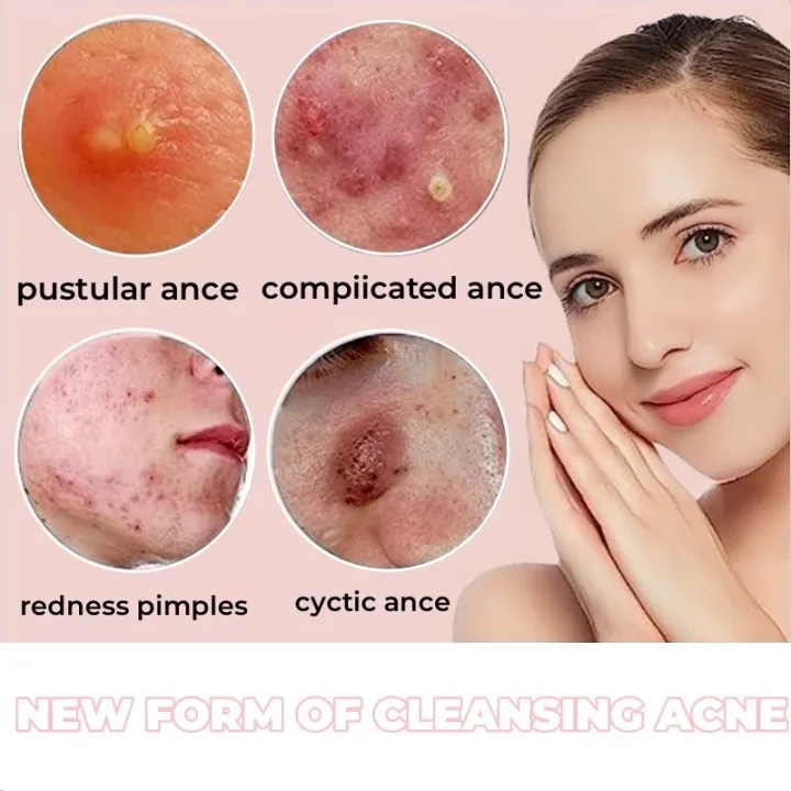 C.three%2036Pcs%20Acne%20Patch%20Salicylic%20Cute%20Star%20Invisible%20Pimple%20Acne%20Remover%20Patch%20Sticker%20SkinCare%20Waterproof%20TOPITEM%F0%9F%91%8D%20-%20Image%204