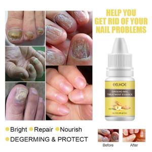Effective Antifungal Serum Ginseng Nail Repair Serum Antifungal Nail Treatment Antifungal Nail Solution Hand and Foot Skin Care Anti Infective Paronychia Onychomycosis Serum 10ml
