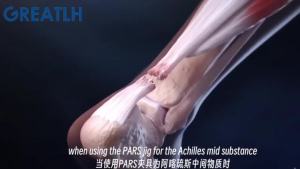 GREATLH Stainless Orthopedic Percutaneous Quadriceps Achilles Tendon Repair Tool with AO Handle Orthopedic Surgical Instruments