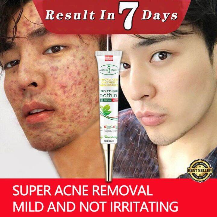 Acne Cream whitening moisturizing cream acne removal essence 30g facial essence cream scar acne remo Pimple Eraser