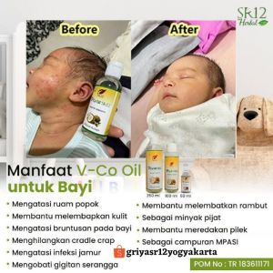 Emran VCO SR12 Minyak Kelapa Obat Gatal Gatal Biang Keringat Ruam Popok Bayi 100% Herbal dan Aman BPOM