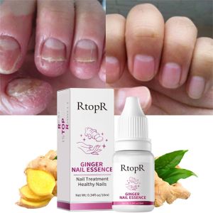 HUOLE RtopR 10ml Ginger Nail Care Essence: A Solution for Onychomycosis & Nail Repair