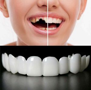2 Pairs Temporarily Adjustable Top and Bottom Enhance Your Smile in Just Minutes(White)