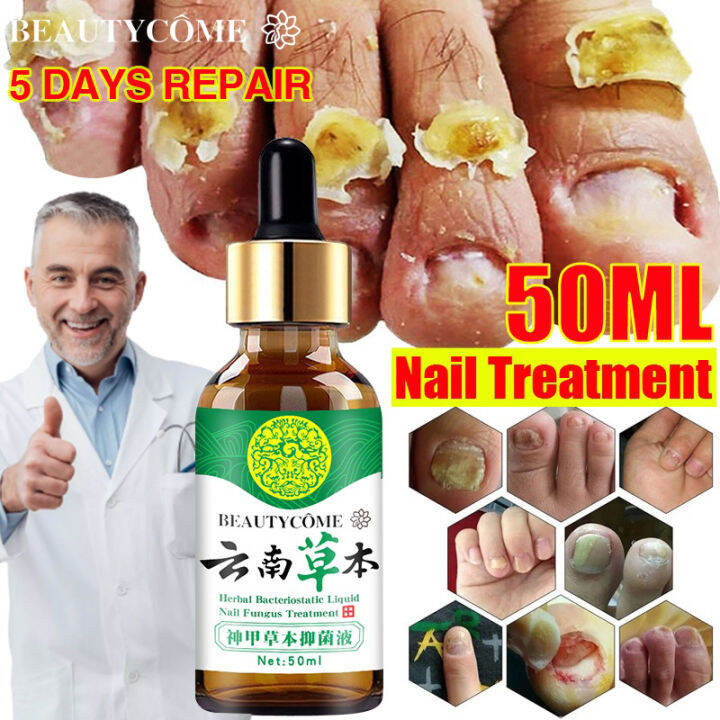 YOUNGCOME 100% Effective Nail Fungus Treatment Serum Footurel Gel Anti ...