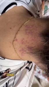 Original 100% Dr. Buddy Soap 100% Purely Natural and Organic Anti Buni An-An Psoriasis