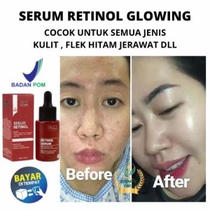 Serum Retinol Sr12 Serum Wajah Glowing Cocok Untuk Semua Masalah Kulit Flek Hitam Jerawat Kusam Bpom