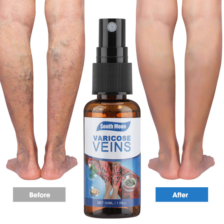 Hailicare varicose vein spray active loose spray smoothes out blood ...