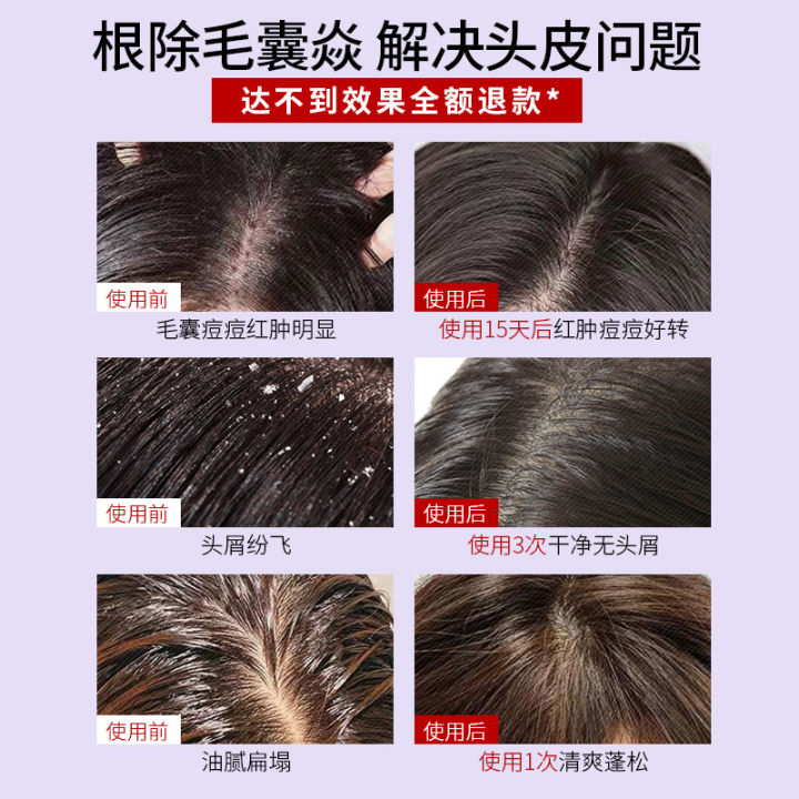 2024 Scalp & Hair Follicle Shampoo - Antibacterial, Anti-Itch, Controls Oil & Mites