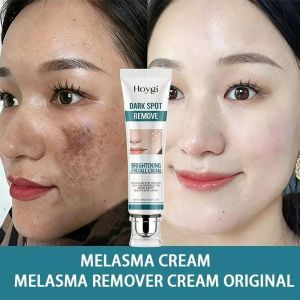 Melasma Cream Original Pekas Remover Anti Melasma Cream Effective for Dark Spots Freckles Face Care 20g