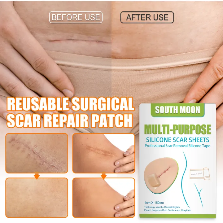 JKS%EF%BC%884*150cm%EF%BC%89South%20Moon%20Silicone%20Scar%20Sheet%20High%20Efficiency%20Surgical%20Silicone%20Gel%20Tape%20Removal%20Scar%20Tape%20Treatment%20-%20Image%206