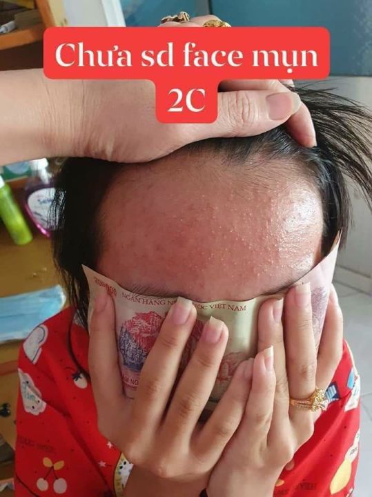 Combo%205%20H%E1%BB%99p%20Kem%20M%E1%BB%A5n%202C%20-%20Image%204