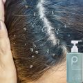 shampoo kelemumur anti dandruff shampoo dandruff treatment oil control sea salt Shampoo syampoo kelemumur syampu 去屑洗发露 Deep clean scalp reduce dandruff hair treatment removes mites Scalp Care scalp Relieve itchy scalp anti hair loss shampoo. 